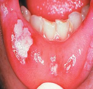 Grade 2 Grade 3 Grade 4 None Soreness, redness MuGard provides effective management of oral