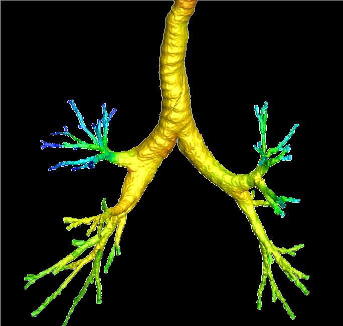 combination of High Resolution CT Thorax (HRCT) Flow simulations