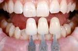 Practical Procedure Shade determination tooth shade, preparation shade Block selection using the IPS e.