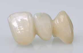 max ZirCAD LT is predestined for the fabrication of restorations, for which combinations of full-contour, partially veneered and/or fully veneered restoration units are required.
