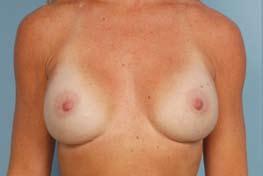Breast examination revealed the inferior border of the pectoralis major muscles (PMMs) to be at the upper poles of the breasts, so that there was minimal muscle coverage of the implants.