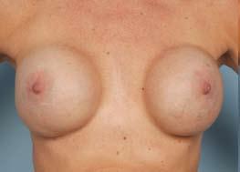 This approach reduced, but did not eliminate, the rippling. However, her breasts appeared round and hard and were uncomfortable.