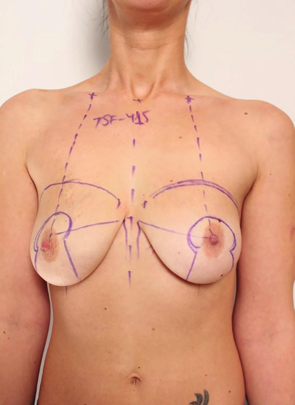 Vikšraitis et al. 3 Like any other operation, this procedure also has its general risk.