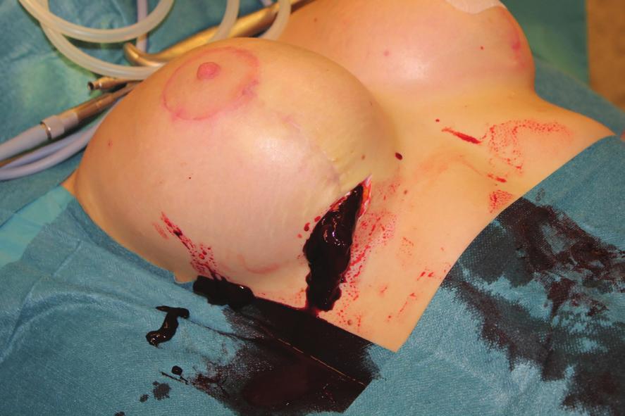 Bleeding from one of the internal mammary artery branches in the implant pocket between the rib cage and the pectoral muscle lower pole was detected and stopped.