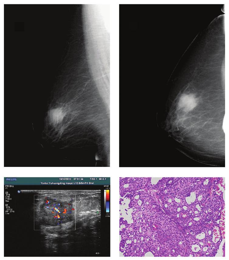 1754 CONG et al: INVASIVE CRIBRIFORM CARCINOMA OF THE BREAST A B C D Figure 1. Case 5 from Table I (A) Oblique and (B) axial mammography findings. A high uneven density mass measuring 2.