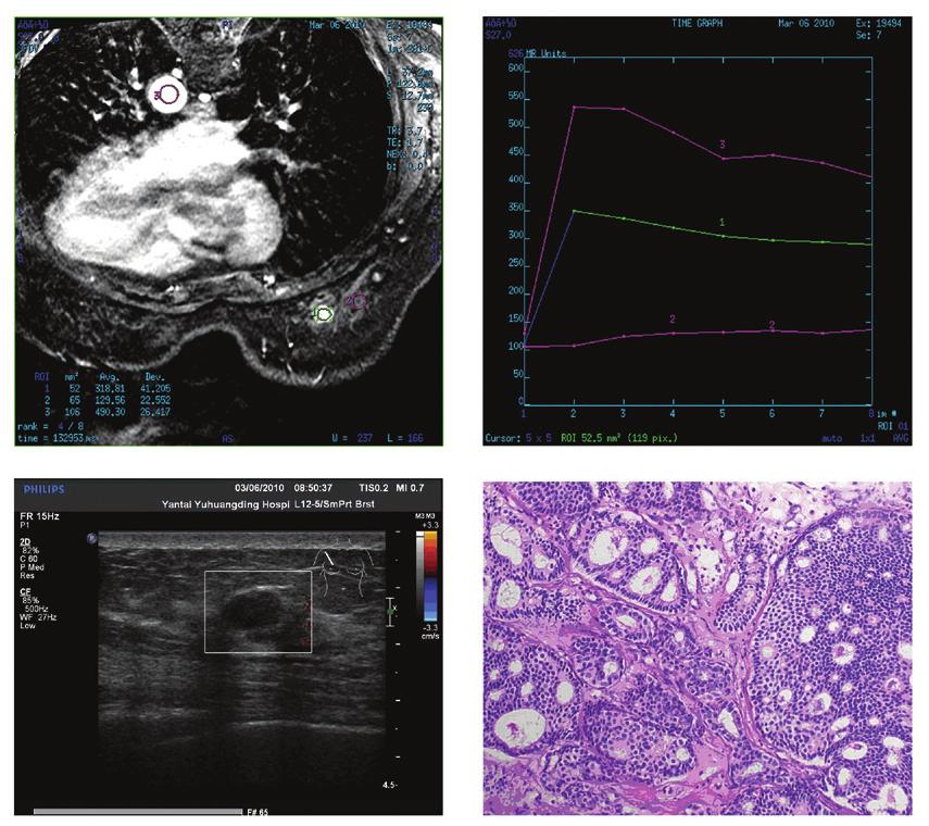 1756 CONG et al: INVASIVE CRIBRIFORM CARCINOMA OF THE BREAST A B C D Figure 2. Case 4 from Table I. (A and B) Magnetic resonance imaging findings. The mass measuring 1.3x0.