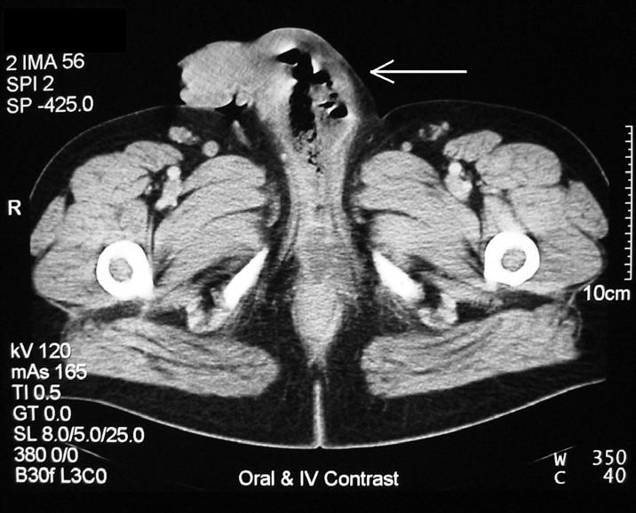 FIGURE 1. Demonstrating oedema of the scrotum and penis, with gas in the left corpus spongiosum extending into the urethra.