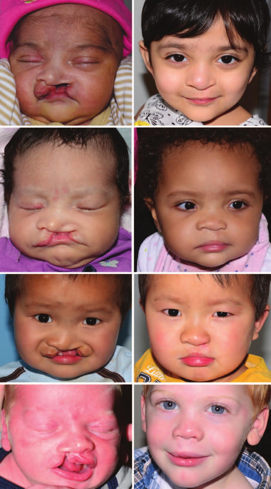 Volume 135, Number 5 Fat Grafting in Primary Cleft Lip Repair Fig. 1. Patient examples of cleft lip repairs using fat grafting.