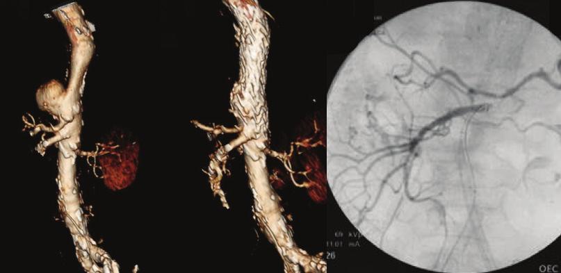 Figure 4. Distal thoracic aortic aneurysm adjacent to the celiac trunk. Preoperative TeraRecon 3D reconstruction showing aneurysm and adjacent vessels (A).
