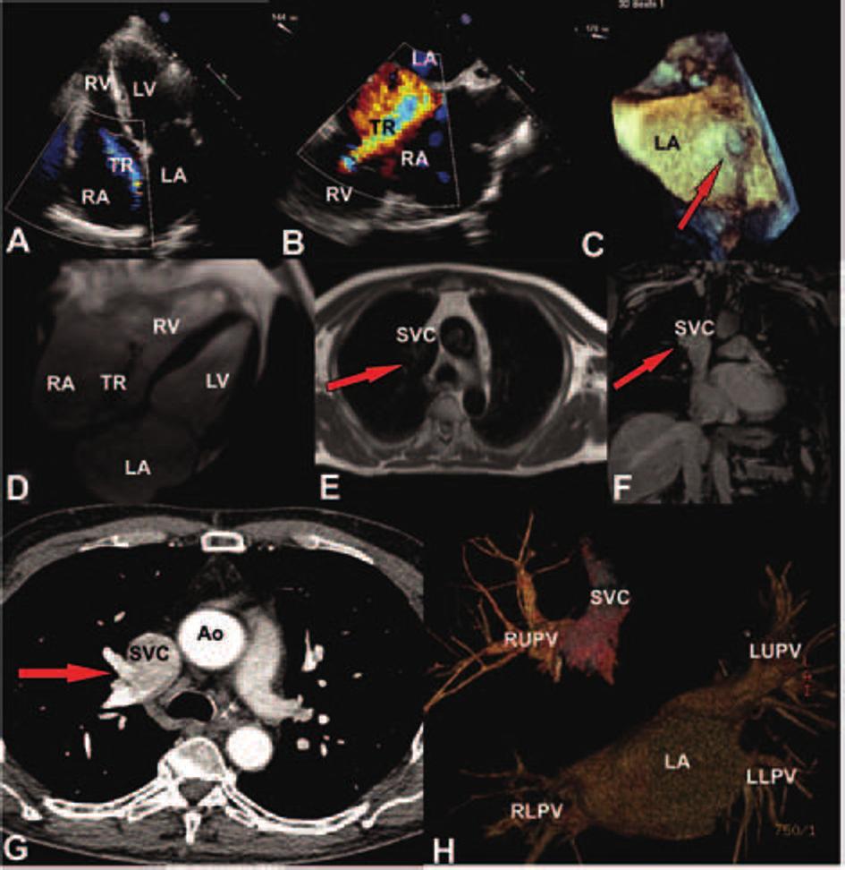 Partial anomalous pulmonary venous connection Figure 1. Ultrasound, CMR and CT images of 69-year-old male with isolated partial anomalous pulmonary venous connection.
