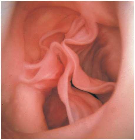Endoscopic View of