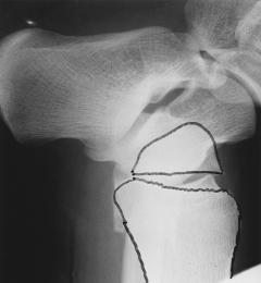 COMPETENCE OF THE DELTOID LIGAMENT IN BIMALLEOLAR ANKLE FRACTURES 845 Results One medial malleolar fracture in a sixty-four-yearold woman with a Lauge-Hansen 7 type-4 supinationexternal rotation