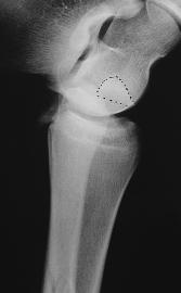 Comparison of the fractures with a positive stress radiograph with those with a negative stress radiograph revealed significant differences (p < 0.05) in the medial malleolar height (1.3 ± 0.