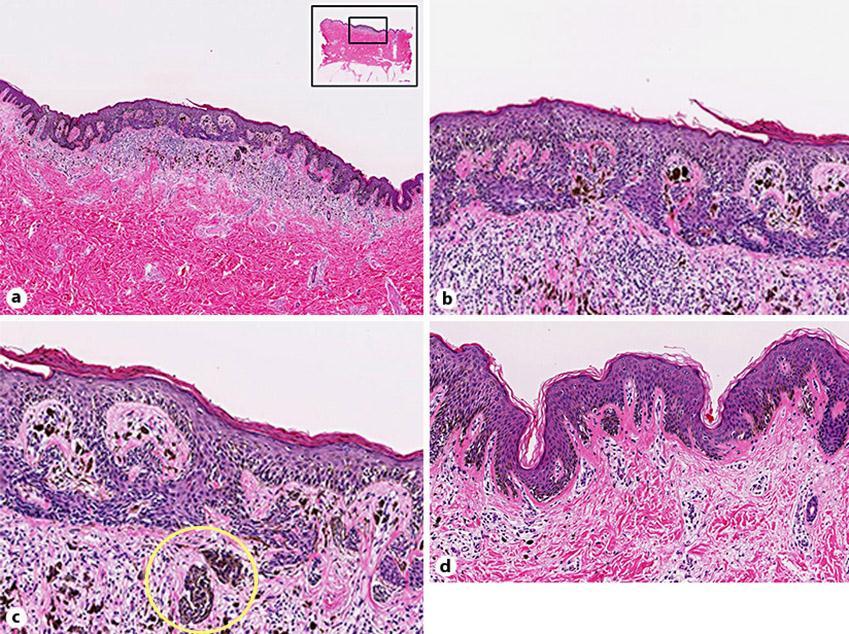 127 Fig. 3. Histopathologic findings. a Mild acanthosis and an irregular distribution of melanin deposition in the epidermis and the dermis were seen in the low-power view.