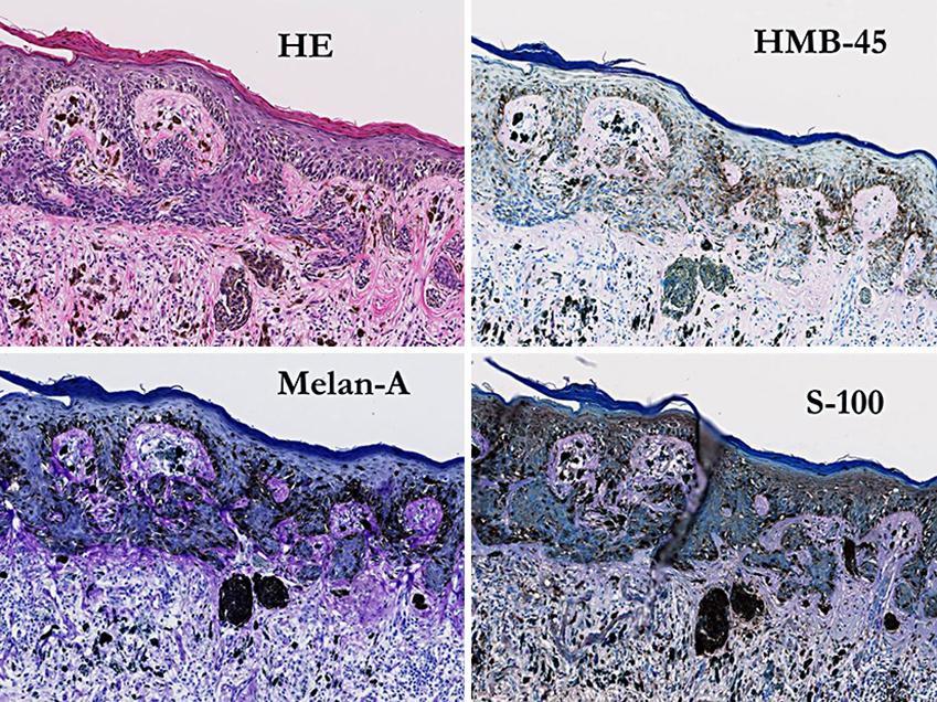 128 Fig. 4. Immunohistochemical findings. Atypical melanocytes in the epidermis were positive for Melan-A, HMB-45 and S-100.