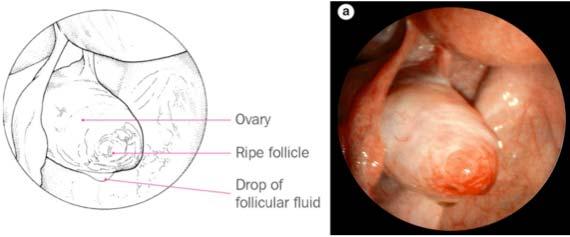 The menstrual cycle: ovulation Laparoscopic view at the time of ovulation during the menstrual cycle, in humans The menstrual cycle: summary Players involved in the cyclic events occurring during the