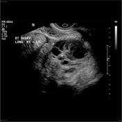 Diagnosis Tubo-ovarian abscess Complex