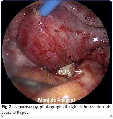 Diagnosis Tubo-ovarian abscess Inflamed and suppurative fallopian tube adhered to the ovary Tubo-ovarian complex if planes still present