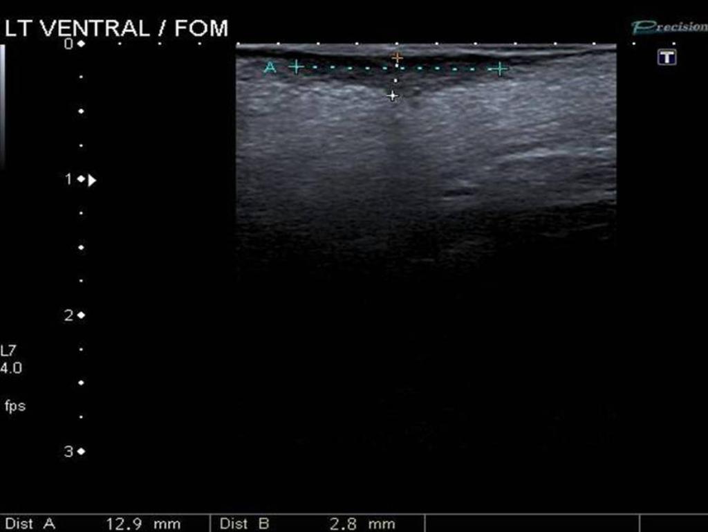 Fig. 6: Ultrasound image of tongue