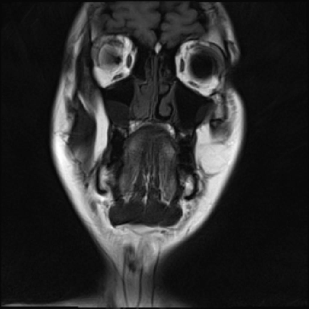 Fig. 10: Case 1 - Coronal T1 weighted image of