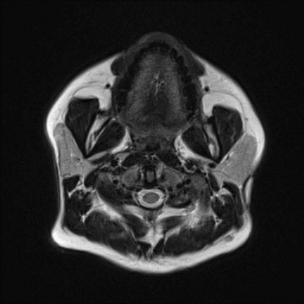 Fig. 12: Case 1 - Axial T2-weighted image of