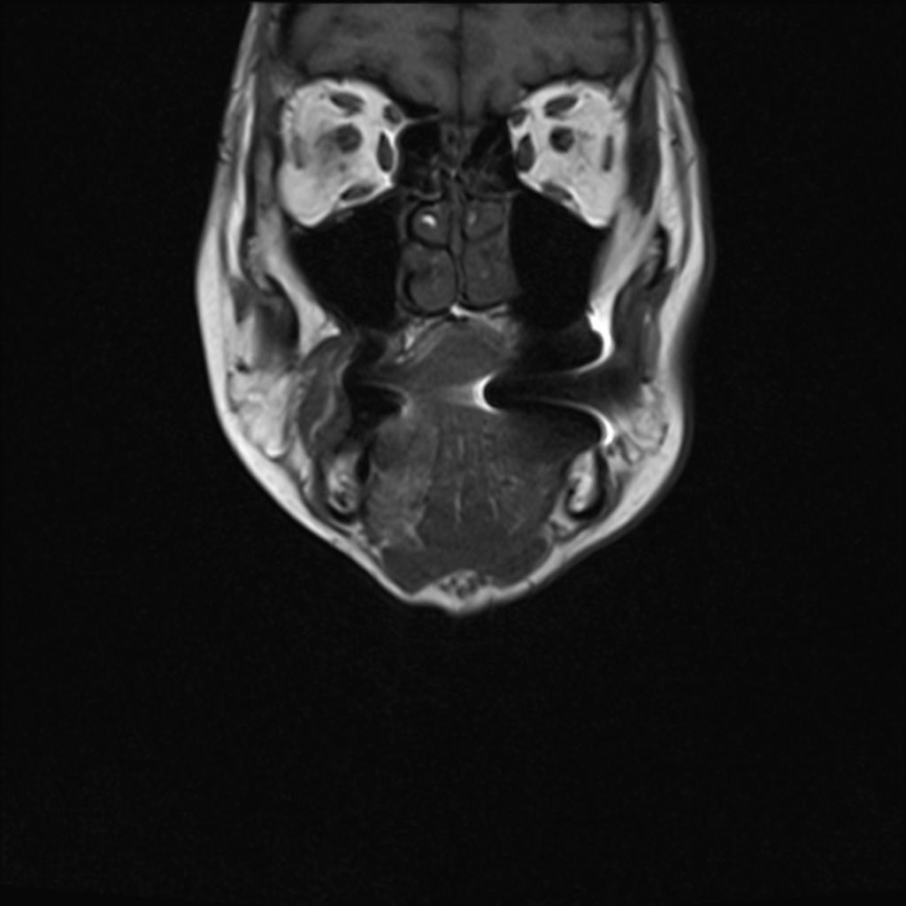 Fig. 14: Case 2 - Coronal T1 weighted MR image of the tongue with