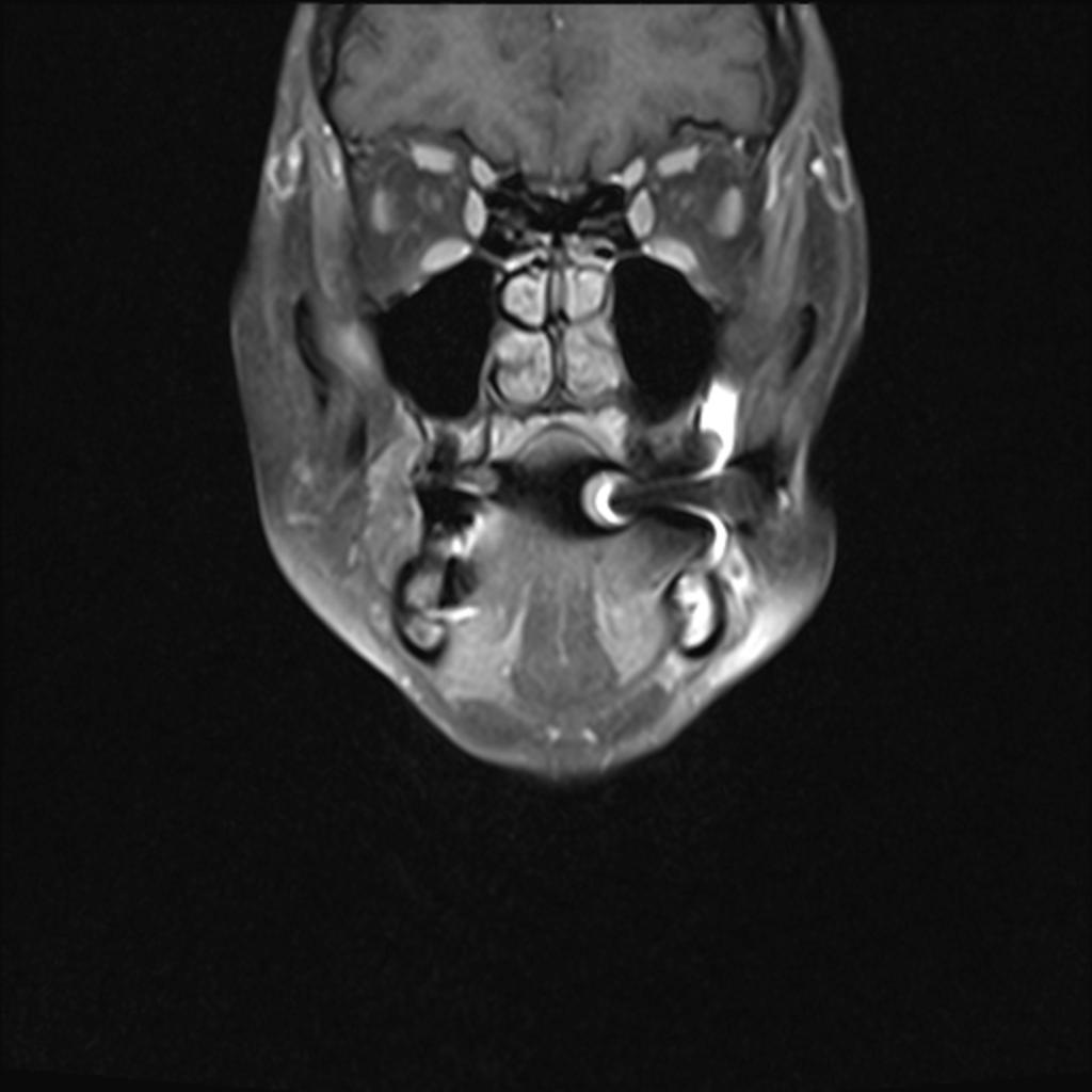Fig. 16: Case 2 - Coronal fat-saturated contrast enhanced MR image of the tongue