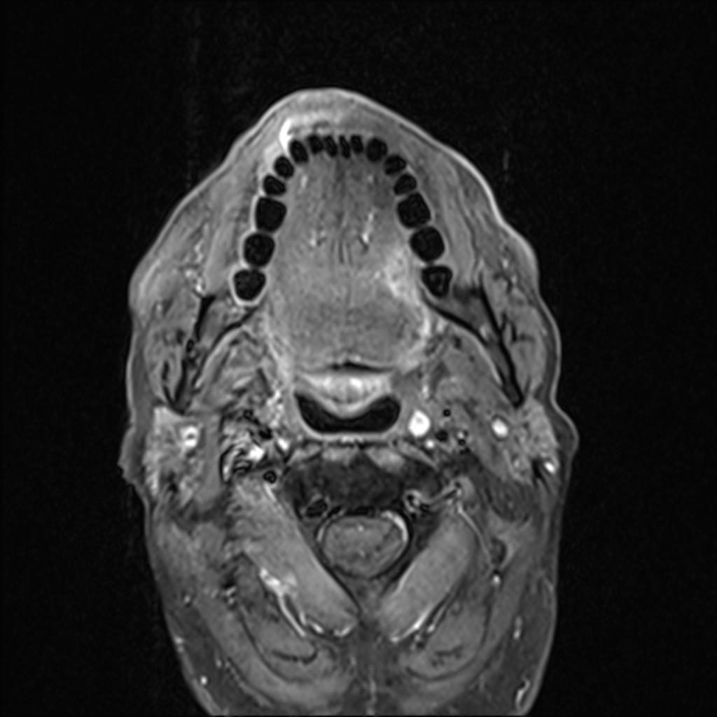 Fig. 20: Case 3 - Axial fat saturated, contrast enhanced T1 weighted image