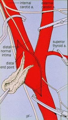 Carotid endarterectomy (CEA), the surgical approach CEA Surgical invasive procedure Clamping CA Artery incision