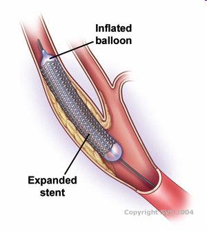 VESSEL DILATION and STENT