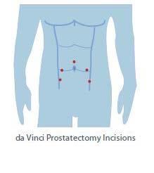 Da Vinci Prostatectomy A Less Invasive Surgical Procedure This procedure incorporates a state-of-the-art surgical system that