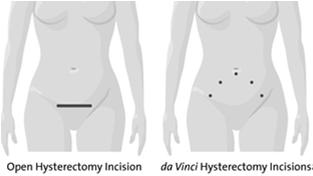 Goals of da Vinci Hysterectomy Enable more precise, meticulous dissection Around ureters & bladder Colpotomy Increase ability to visualize & dissect compromised anatomy & tissue planes Endometriosis,