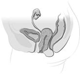 Precise, 3-layer suture reconstruction of uterus Sacral colpopexy considered gold standard for vaginal vault prolapse <5% performed with laparoscopy Difficult dissections & extensive suturing da
