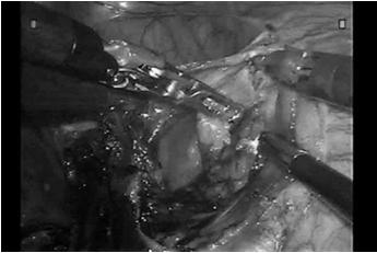 Double-click to view video Video courtesy of Javier F. Magrina, M.D. Better access & visualization enable more precise dissection Precise, controlled dissection around arteries, veins, nerves Access