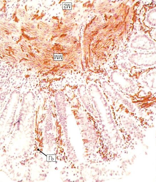 Figure 2. Hirschsprung s Disease. Rectal Biopsy. Micrograph showing prominent nerve twigs in the lamina propria (LP), muscularis mucosae (MM) and submucosa (SM) 2.