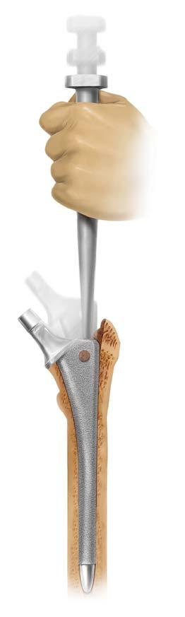 Femoral Component Insertion Introduce the hip stem to the medullary canal. Rotate the stem into proper orientation and advance the stem into the canal using hand pressure (Figure 15).