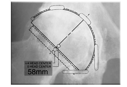 Measure the distance from the lesser trochanter landmark to the reference line on each side. The difference between the two is the radiographic leg length discrepancy.