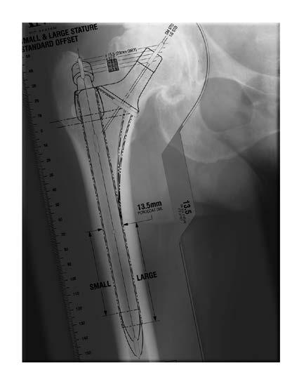 Femoral Templating Determining Stem Diameter: Position the femoral template overlay along the long axis of the femur (Figure 3).
