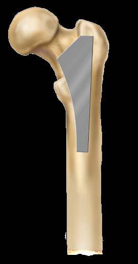 Femoral Neck Resection Osteotomize the femoral neck at a 45-degree angle using the neck resection guide.