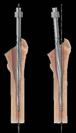 Neither the diameter nor location of the pilot hole should inhibit access to the femoral canal by the straight diaphyseal reamers.