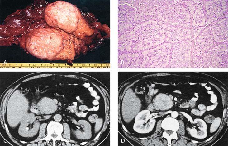 Chapter 4.10 Pancreatic Neoplasms and Tumor-like Conditions 421 Macroscopically, the pancreatic head (Fig.
