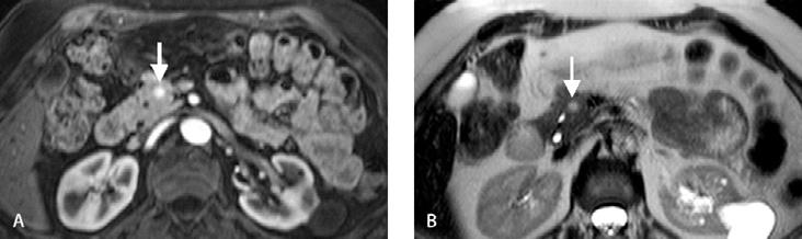 Chapter 4.10 Pancreatic Neoplasms and Tumor-like Conditions 427 Fig. 22A, B. Endocrine hyperfunctioning tumor (insulinoma), MR study.