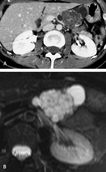 tree upstream (B). Ascites is present (arrow in A) Fig. 30A, B. Mixed (micro- and macrocystic) serous cystadenoma.