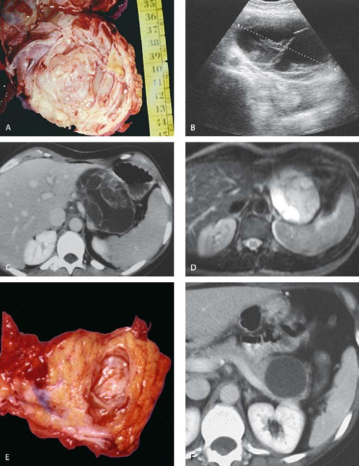 Chapter 4.10 Pancreatic Neoplasms and Tumor-like Conditions 435 Clinically, when the tumor is small, it is almost always encountered incidentally.