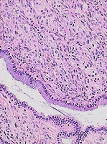 436 Giovanni Carbognin, Lucia Pinali, Carlo Procacci ( ) The diagnosis is almost certain when identification is incidental, yet not justified by a clinical picture of acute or chronic pancreatitis, a