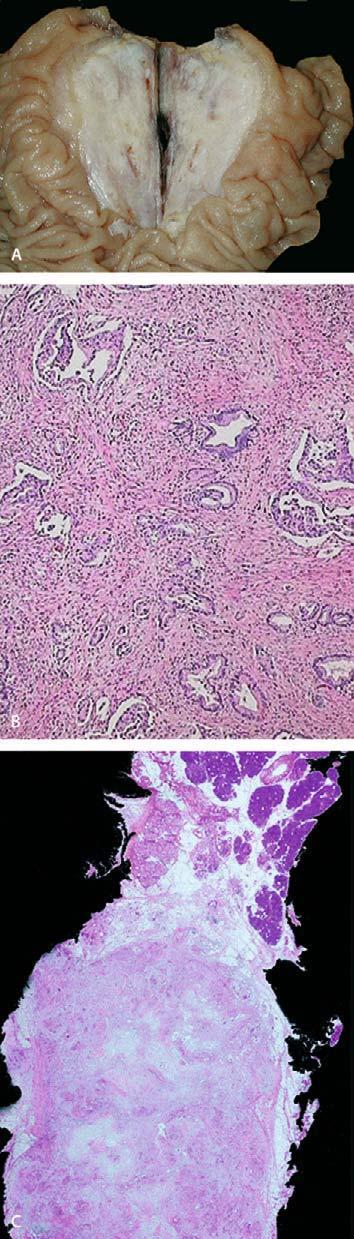 Chapter 4.10 Pancreatic Neoplasms and Tumor-like Conditions 411 Fig. 1A C. Ductal adenocarcinoma. A Whipple resection specimen showing ill-demarcated tumor in the head of the pancreas.