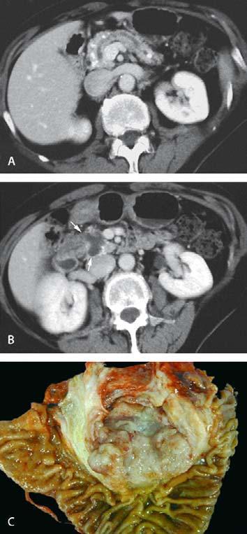 438 Giovanni Carbognin, Lucia Pinali, Carlo Procacci ( ) Fig. 33A C. Intraductal papillary mucinous tumor of the main duct.