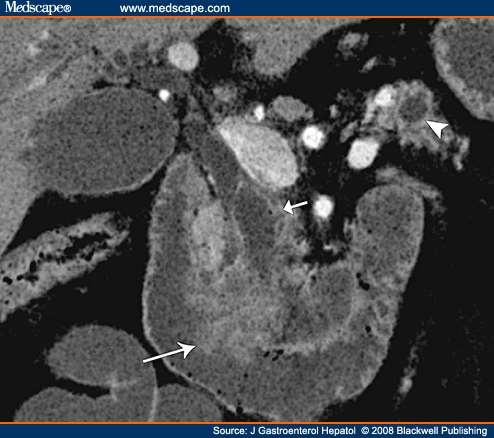 Clinical and Radiological Features 60-80 y.o. M>F Radiating epigastric pain with wt.
