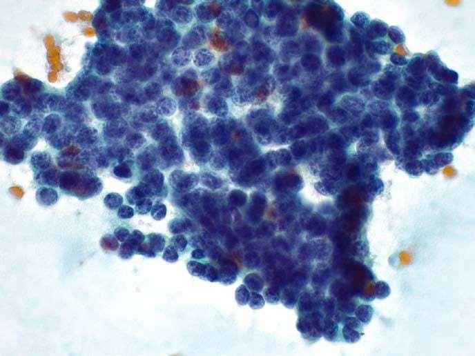 Cytological Features of Pancreatic Endocrine tumours Typical