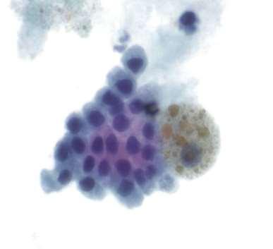 Cuboidal non-mucinous epithelial cells Hemosiderin-laden
